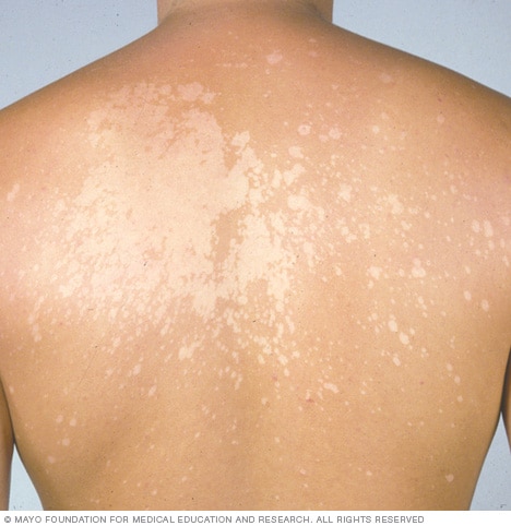 <p>Tinea versicolor</p>