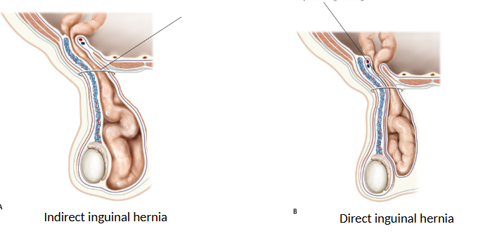 <ul><li><p><strong>direct</strong> → through inguinal<strong>/hesselbach </strong>triangle (not scrotum)</p><ul><li><p>med. to epigastric a.</p></li></ul></li><li><p><strong>indirect </strong>→ through <strong>deep inguinal ring</strong> (in scrotum)</p><ul><li><p>lat. to epigastric a.</p></li></ul></li><li><p>femoral → inf. to inguinal lig. w/in femoral canal</p></li></ul><p></p>