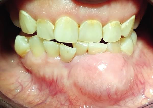 <p><span><span>Expansión ósea lenta y desplazamiento dental</span></span></p>