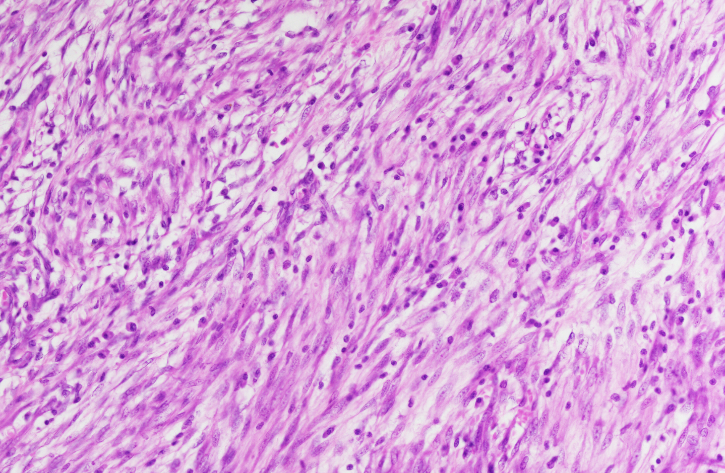 <p>Tumeur plèvre enfant </p><p>Diagnostic</p><p>Age</p><p>localisation</p><p>Histologie </p><p>IHC</p>