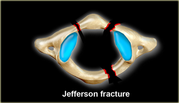 <p>jefferson fx- radiographic appearance</p>