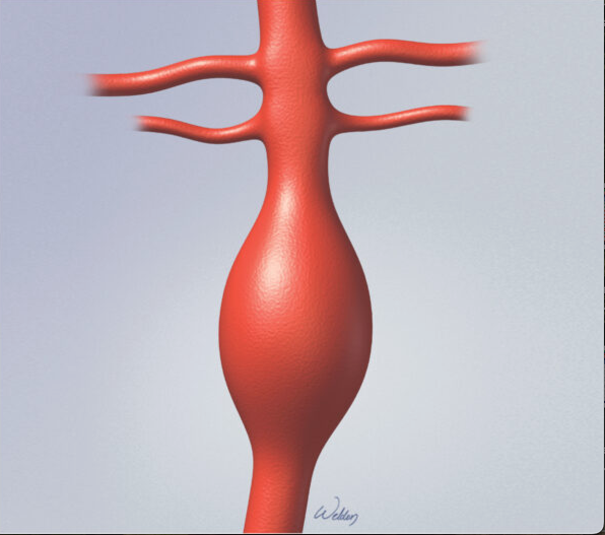 <p><span>a type of blood vessel dilation where the entire circumference of the artery wall stretches and enlarges, forming a spindle-shaped ballooning</span></p><p><span>commonly occur in the aorta or cerebral arteries</span></p>