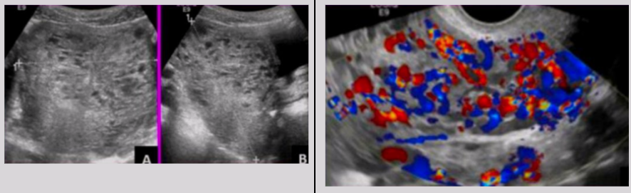 <ul><li><p><span style="background-color: transparent;">Focal/diffuse echogenic material in endometrium</span></p><ul><li><p><span style="background-color: transparent;">Possible extension to myometrium</span></p></li></ul></li><li><p><span style="background-color: transparent;">Irregular sonolucent areas surrounding trophoblastic tissue</span></p></li><li><p><span style="background-color: transparent;">Swiss-cheese appearance&nbsp;</span></p></li><li><p><span style="background-color: transparent;">Hypervascular</span></p></li><li><p><span style="background-color: transparent;">Theca-lutein cysts</span></p></li></ul><p></p>