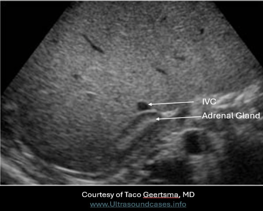 <p>A. posterior to the IVC</p><p>Right Adrenal Gland - medial to right lobe of liver; posterior to IVC; superomedial to the kidney; lateral to the right crura</p>