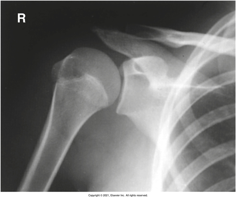 <p>correct rotation is evidenced by glenohumeral joint should be open, anterior and posterior rims of glenoid should be superimposed </p>