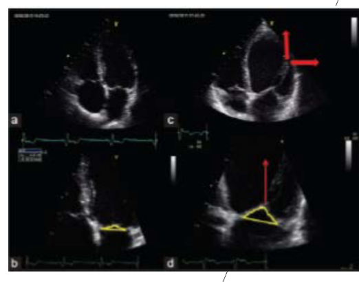 <p>Tethering or tenting of MV leaflets due to LV remodeling (this secoundary / functional)</p>