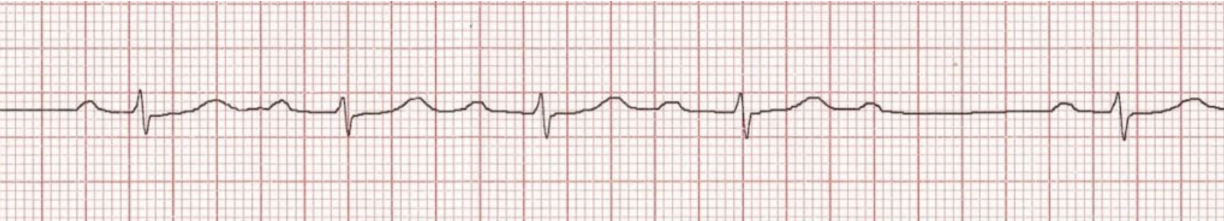 <p>What rhythm/abnormality is seen below?</p>