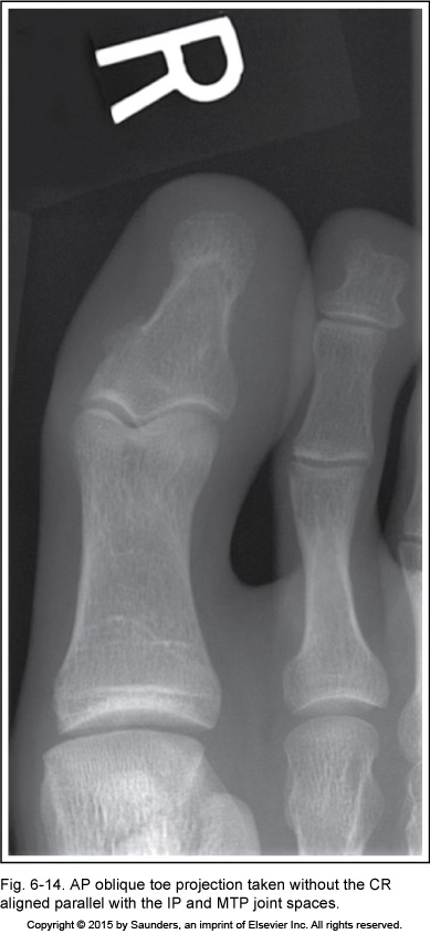 <p>AP oblique toe</p>
