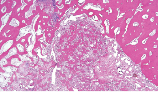 <p>Lésion métaphyse tibia garçon de 10 ans</p><p>Diagnostic</p><p>Définition</p><p>Age</p><p>Topographie</p><p>Anatomie</p><p>Clinique</p><p>Histologie</p><p>Moléculaire</p>