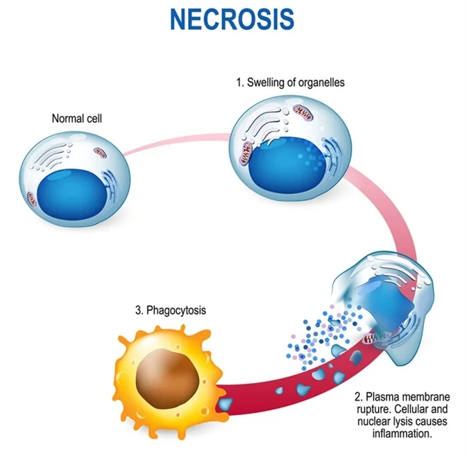 <p>Cell death that is accidental and uncontrolled. Caused by loss of blood supply, exposure to toxins, cellular swelling, protein denaturation. Results in tissue dysfunction.</p>