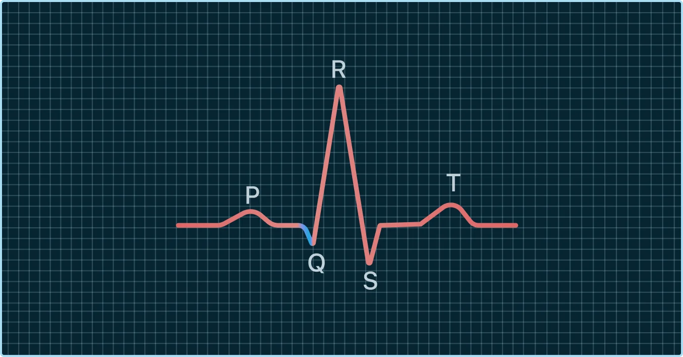 <p>P wave</p>