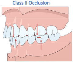 <p>Class II</p>