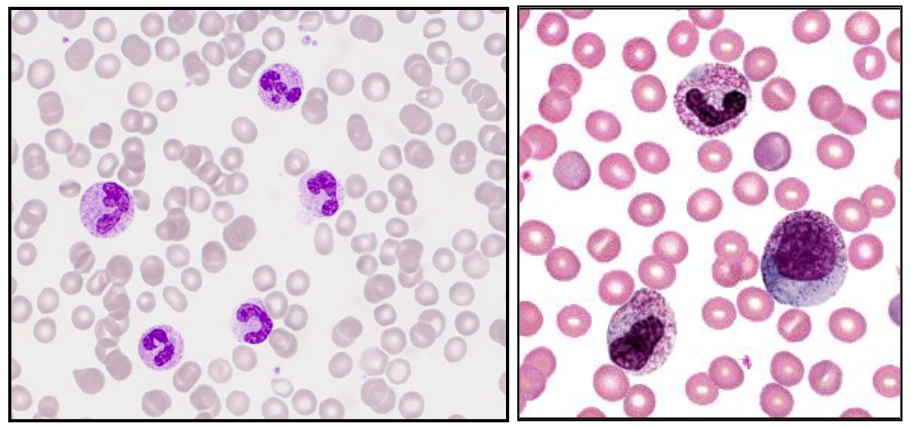 <p>- Increase in neutrophils with left shift and increased granulation</p><p>- secondary to infection, inflammation, tissue damage, drugs, cytokines</p><p>.</p><p>- A neutrophil left shift signifies an increased number of immature neutrophils (such as band cells) in the bloodstream, indicating the bone marrow is releasing them early to fight acute infection, severe inflammation, or marrow stress. It is a marker of intense, often bacterial, inflammation. (its as if we took the diagram above and turned it so that myeloblasts were on the left)</p><p>.</p><p>- image on the right shows significant left shift</p>
