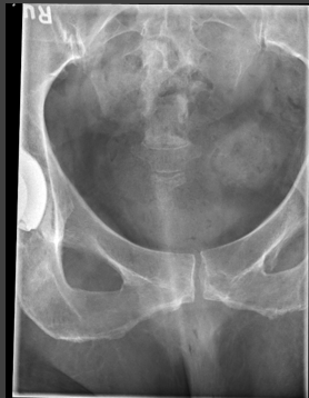 <p>critique for coccyx AP axial </p>