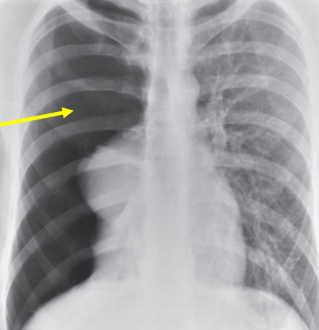 <p>Air in the pleural cavity resulting in partial or complete collapse of the lungs.</p>