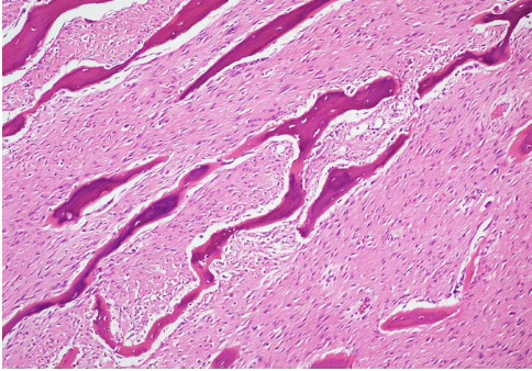 <p>Lésion métaphyse fémur distal postérieur femme de 30 ans</p><p>Diagnostic</p><p>Définition</p><p>Age</p><p>Topographie</p><p>Anatomie</p><p>Histologie</p><p>Moléculaire et IHC </p>