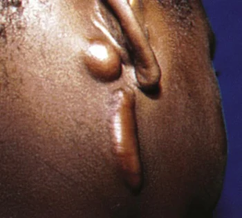 <p>Keloid</p>