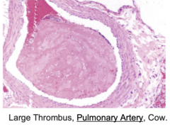 <p>Which process is going on after</p><p>formation of this thrombus?</p><p>A. Recanalization</p><p>B. Organization and fibrosis</p><p>C. Little to no resolution</p><p>D. Complete resolution</p>