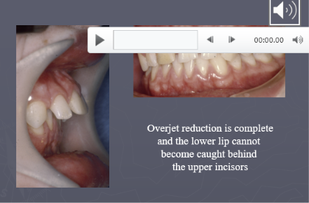 <p><strong>upper incisors are retained by the lower lip</strong></p><p>in the image the lower lip is controlling the upper incisors as a lip seal has been achieved and will aid in stability and prevent relapse</p><p>one of the main aims is to get lower lip control of upper incisors</p>