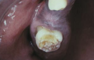 <p>intra-oral presentation of congenital syphilis;1st molars develop irregular nodules of enamel on occlusal surface</p>