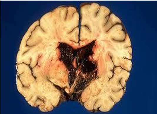 <p>Questions</p><ol><li><p>What is the specimen being examined?</p></li><li><p>What are the specific internal and external findings regarding the injury?</p></li><li><p>What is the possible cause of death?</p></li><li><p>What is the final diagnosis for this specimen?</p></li></ol><div data-type="horizontalRule"><hr></div><p></p><p></p>