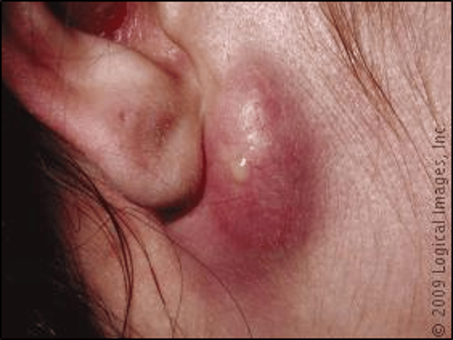 <p>Large protruding pocket like lesion filled with sebum</p>