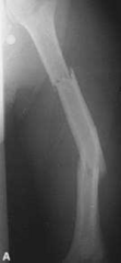 <p>fracture in 2 parts of the same bone</p>