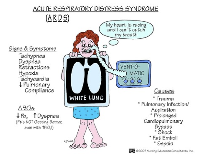 <p>ARDS = severe ARF </p><ul><li><p>ARDS = dyspnea, tachypnea, dec lung compliance, alveolar infiltrates on CXR</p></li><li><p><strong>Berlin Criteria </strong></p><ul><li><p>pt must have acute onset w/in 1 wk after some initial clinical insult </p></li><li><p>bilateral pulmonary opacities (CXR white, opaque) not explained by other conditions </p></li><li><p>altered PaO2:FiO2 ratio = giving high FiO2 and PaO2 not inc </p></li></ul></li><li><p>causes </p><ul><li><p>aspiration, fat embolism, toxic inhalation, drowning, PNA, bypass, OD, sepsis, trauma </p></li></ul></li></ul><p></p>