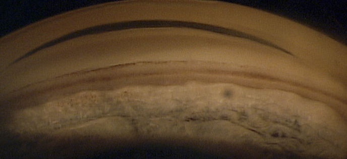 <p>A heavily pigmented line anterior to Schwalbe's line seen on gonioscopy. It is classically associated with:</p><ul><li><p>Pigment dispersion syndrome (PDS)/pigmentary glaucoma</p></li><li><p>Pseudoexfoliation syndrome (PXE)/pseudoexfoliative glaucoma</p></li></ul><p></p>