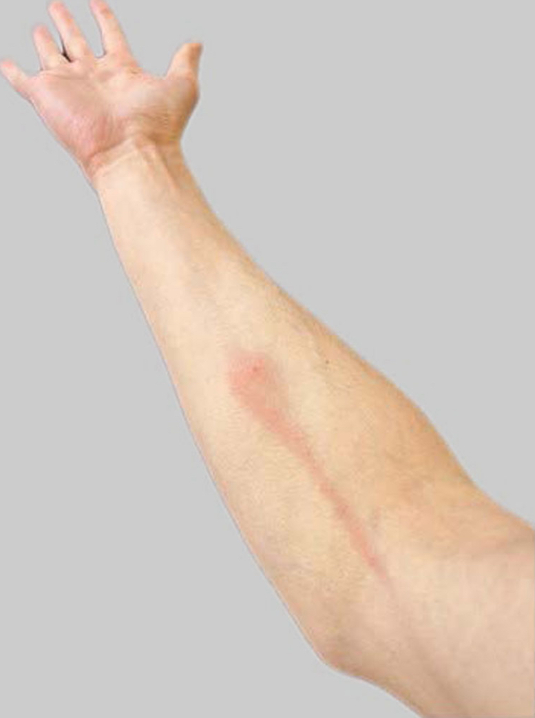 <p><span>Inflammation of the <strong>lymphatic vessels</strong>, usually caused by the spread of infection.</span></p>