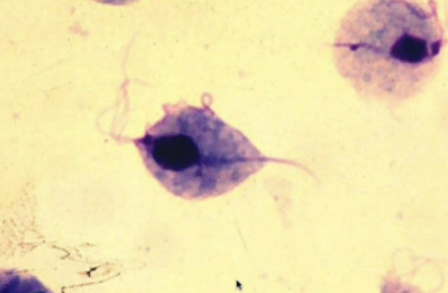 <p>⚠️‼️(#7,#38)65.This organism can cause what type of infection in the lower reproductive tract? A.Molluscum contagiosum B.Chancroid C.Bacterial vaginosis D.Trichomoniasis</p>