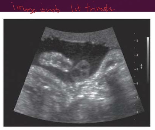 <p>Homogeneous to heterogeneous; begins as thick echogenic ring around gestational sac; primarily medium-level echoes</p>