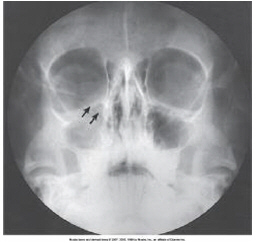 <p>projection (method)</p>