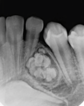 <p>which of the following is true </p><p>treatment is surgcal removal </p><p>known as complex odontoma </p><p>lesion is painful </p><p>occurs in elderly </p>