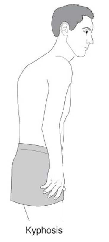 <p>kyphosis </p>