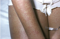 <p>diffuse maculopapular rash after antibiotics (esp ampicillin/amoxicillin)</p>