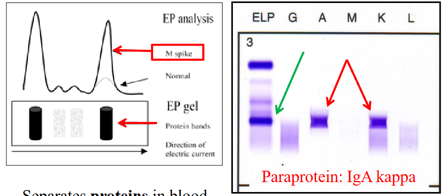 <p>LEFT DIAGRAM: Protein Electrophoresis</p><p>- Separates proteins in blood based on electrical charge</p><p>- Detects "M" proteins</p><p>.</p><p>RIGHT DIAGRAM:</p><p>- Detects and quantifies Ig</p><p>- Identification of paraprotein using antibodies</p><p>.</p><p>- we see an M spike which indicates paraproteins in blood</p><p>- the right diagram shows that there is presence of IgA Kappa Paraprotein</p>