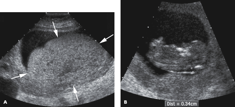 <p>2. The patient in Figure 23-28 presented to the sonography department with nausea and vomiting, and a markedly elevated hCG level. What is the most likely diagnosis?</p><p></p><p>a. Miscarriage</p><p>b. Partial molar pregnancy</p><p>c. Complete molar pregnancy</p><p>d. Ectopic pregnancy</p>