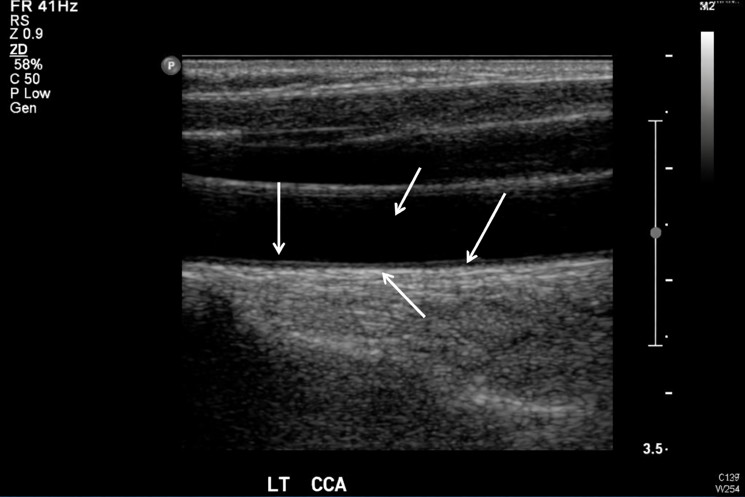 <p>Label the anatomy of this Carotid Artery</p>