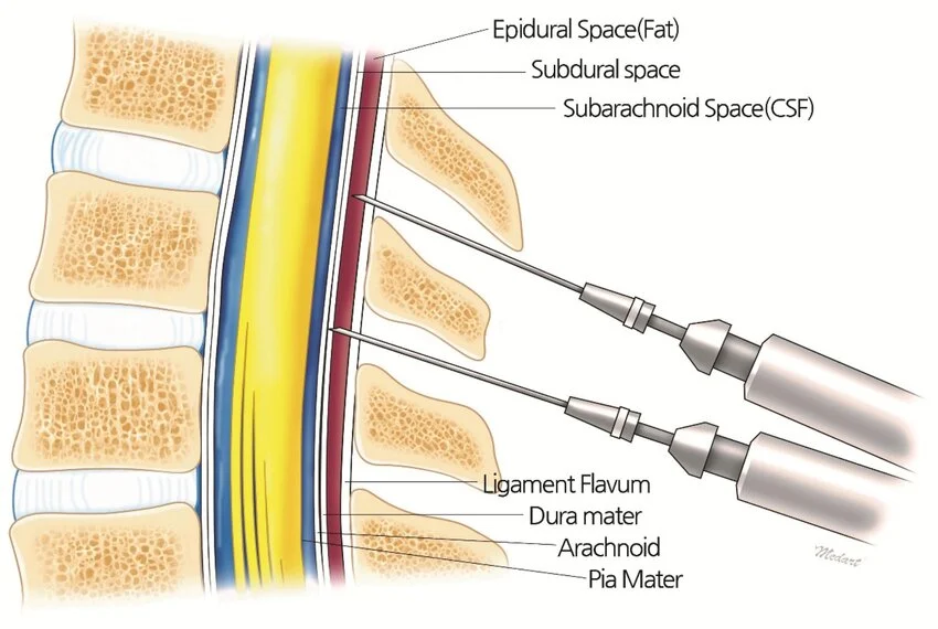 <p>Spinal anesthesia</p>