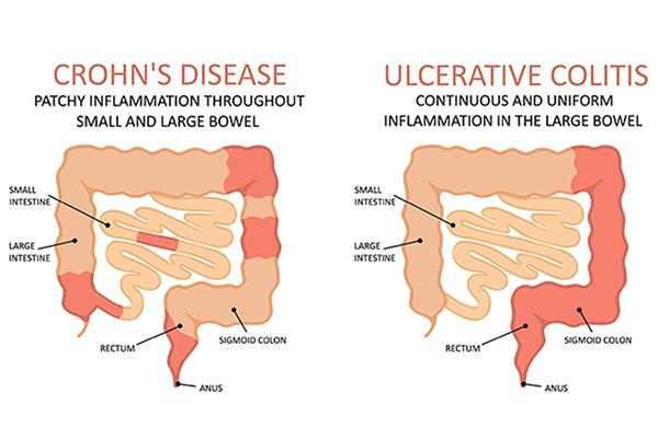 <p>CD: small bowel (terminal ileum) and right colon</p><p>patchy</p><p>transmural, fistulas, strictures, seositis</p><p>non caseating granuloma</p><p>poor resp to surg</p><p>increased risk for cancer</p><p>UC: colon only, begin at rectum</p><p>continous, not transmural</p><p>superficial inflammation</p><p>no granulomas</p><p>good resp to surg</p><p>increased risk for cancer</p>