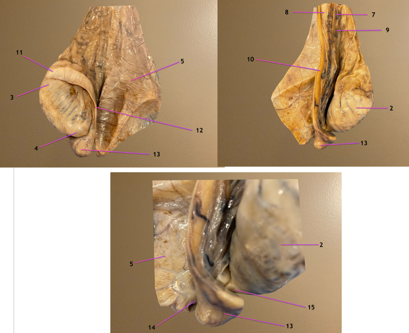 <p>pic 1/2: parietal vaginal tunic opened</p><p>pic 3: same but zoomed in to see 14 &amp; 15</p><p>.</p><p>label 2-5</p>