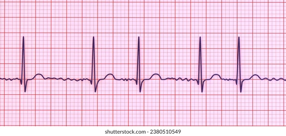 <p>What are <strong>atrial fibrillation</strong> EKG <strong>features</strong> and <strong>risks</strong>?</p>