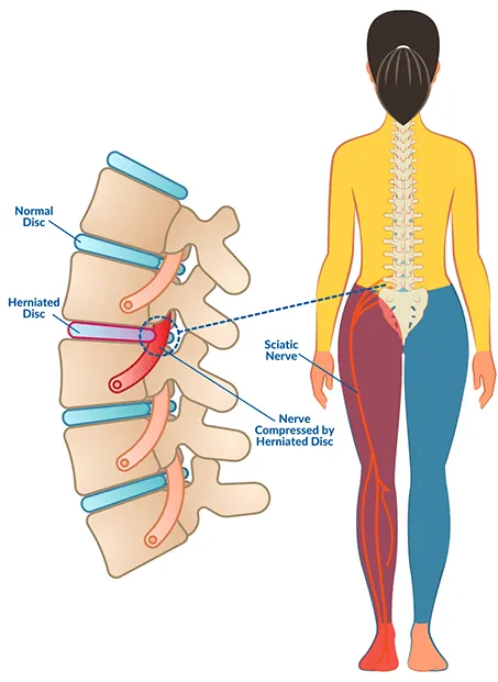 <p>Slipped disc</p>