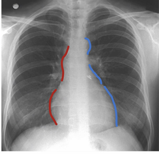 <ul><li><p>Aortic arch or knob</p></li><li><p>Left atrial appendage</p></li><li><p>Left ventricle</p></li></ul><p></p>