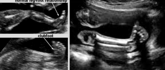 <ul><li><p><span style="background-color: transparent;">Most common skeletal anomaly seen in routine OB exams</span></p></li><li><p><span style="background-color: transparent;">Caused by a shortened Achilles tendon → foot turns in and under</span></p></li><li><p><span style="background-color: transparent;">Twice as common in males</span></p></li><li><p><span style="background-color: transparent;">Can be an isolated finding or part of a syndrome</span></p><ul><li><p><span style="background-color: transparent;">Meckel-Gruber, triploidy, Ehlers Danlos, Ellis Van Creveld, Noonan syndrome, trisomy 13, trisomy 18</span></p></li></ul></li><li><p><span style="background-color: transparent;">Treatment - casting and bracing</span></p></li></ul><p></p>