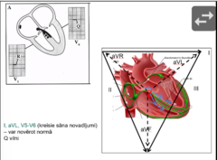 <p>- var novērot normā Q vilni</p><p>elektriskais impulss izplatās tā: iet uz Hisa kopējo stumbru, depolarizējas starpsienas kreisā puse, tad impulss pārbīdās uz labo pusi un sadalās par diviem zariem</p><p>virziena lūzuma mirklis - tāpēc var redzēt normālus Q viļņus šajos novadījumos (kas pretēji sarkanajai bultiņai</p>