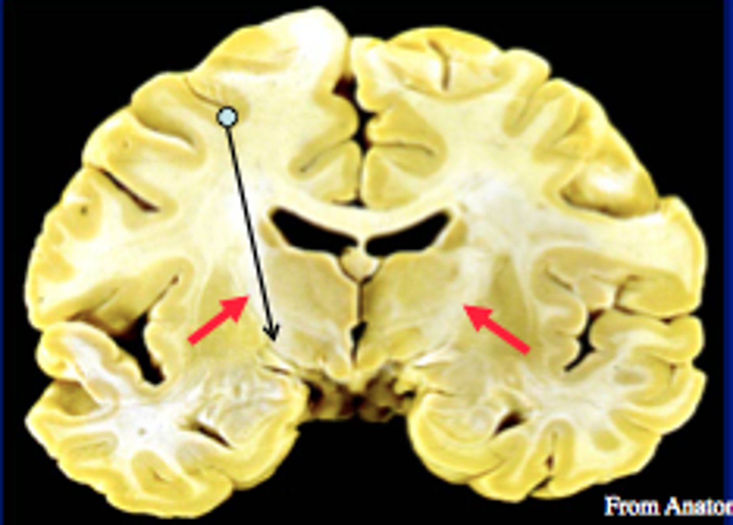 <p>A large group of projection fibers,</p><p>contains sensory and motor tracts that connect the cerebral cortex to the brain stem and spinal cord.</p>