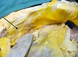 <p>what type of fascia is being indicated to in the image</p>