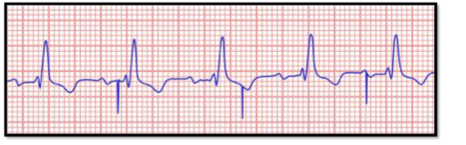 <p><br>The identification of the above ECG is:</p><p>a. Failure to capture </p><p>b. Ventricular pacing</p><p>c. AV sequential pacing</p><p>d. Failure to sense</p>